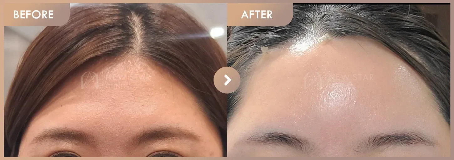 Forehead fillers before-and-after photos at Newstar Clinic