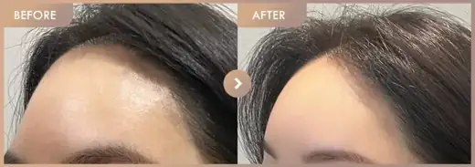 Forehead fillers: before-and-after comparison at Newstar Clinic
