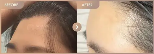 Forehead fillers: before-and-after comparison at Newstar Clinic