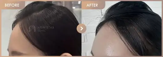 Forehead fillers: before-and-after comparison at Newstar Clinic