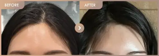 Forehead fillers: before-and-after comparison at Newstar Clinic