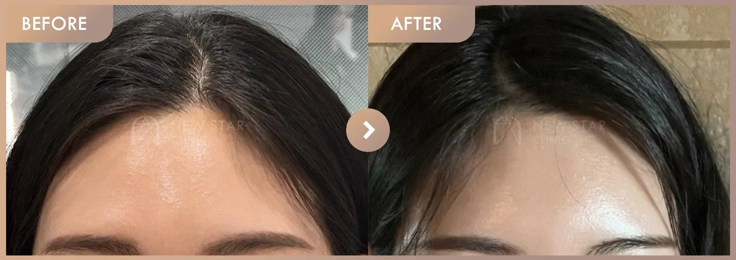 Forehead fillers before-and-after photos at Newstar Clinic