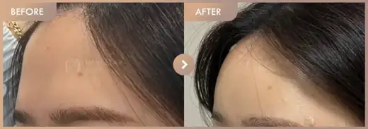 Forehead fillers: before-and-after comparison at Newstar Clinic