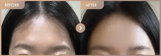 Forehead fillers: before-and-after comparison at Newstar Clinic