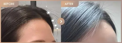 Forehead fillers: before-and-after comparison at Newstar Clinic
