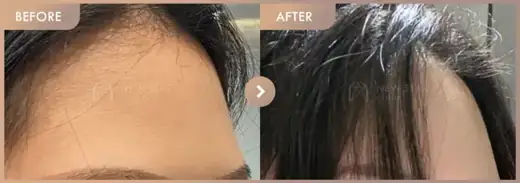 Forehead fillers: before-and-after comparison at Newstar Clinic