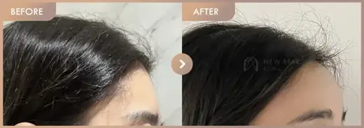 Forehead fillers: before-and-after comparison at Newstar Clinic