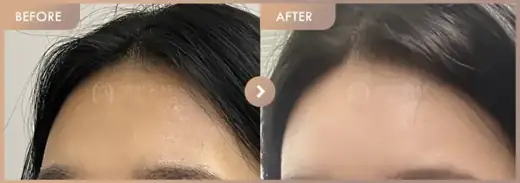 Forehead fillers: before-and-after comparison at Newstar Clinic