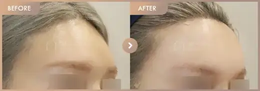 Forehead fillers: before-and-after comparison at Newstar Clinic