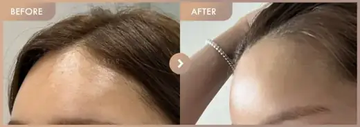 Forehead fillers: before-and-after comparison at Newstar Clinic