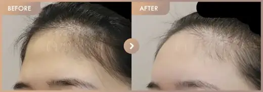 Forehead fillers: before-and-after comparison at Newstar Clinic