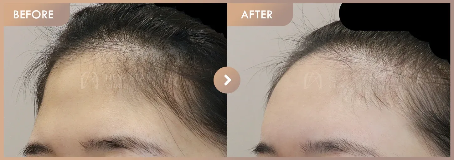 Forehead fillers before-and-after photos at Newstar Clinic