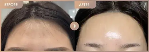 Forehead fillers: before-and-after comparison at Newstar Clinic