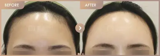 Forehead fillers: before-and-after comparison at Newstar Clinic