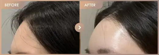 Forehead fillers: before-and-after comparison at Newstar Clinic