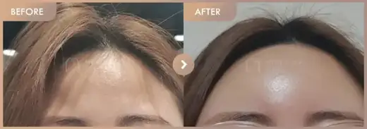 Forehead fillers: before-and-after comparison at Newstar Clinic