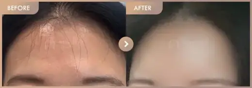 Forehead fillers: before-and-after comparison at Newstar Clinic