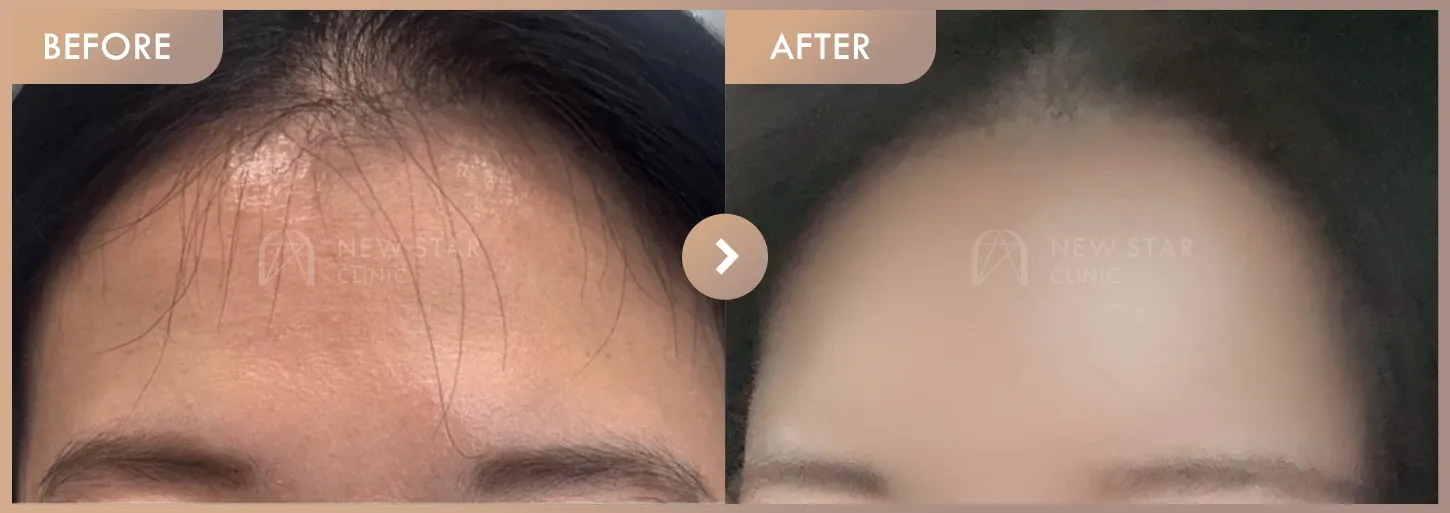 Forehead fillers before-and-after photos at Newstar Clinic