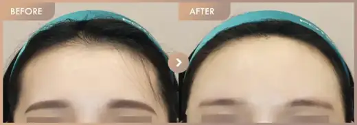 Forehead fillers: before-and-after comparison at Newstar Clinic