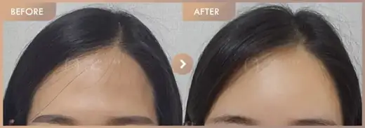 Forehead fillers: before-and-after comparison at Newstar Clinic