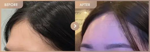 Forehead fillers: before-and-after comparison at Newstar Clinic