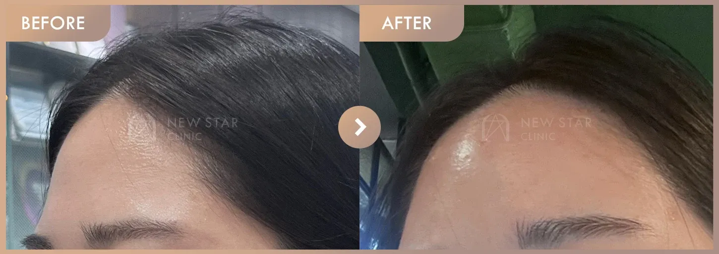 Forehead fillers before-and-after photos at Newstar Clinic