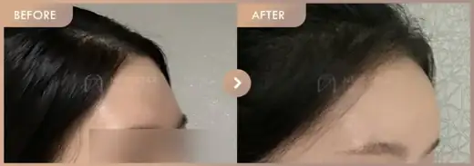 Forehead fillers: before-and-after comparison at Newstar Clinic