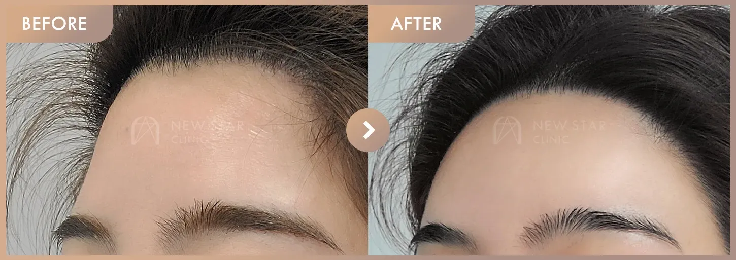 Forehead fillers before-and-after photos at Newstar Clinic