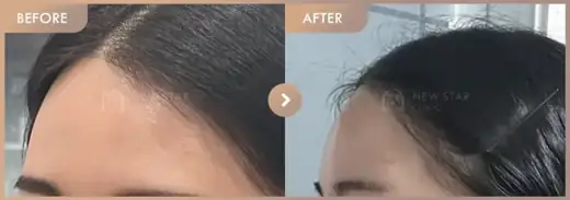 Forehead fillers: before-and-after comparison at Newstar Clinic