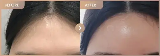 Forehead fillers: before-and-after comparison at Newstar Clinic
