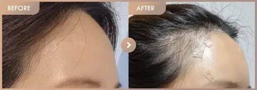 Forehead fillers: before-and-after comparison at Newstar Clinic