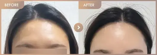 Forehead fillers: before-and-after comparison at Newstar Clinic