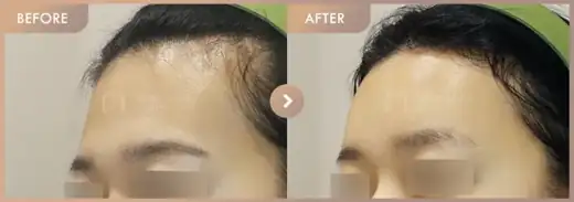 Forehead fillers: before-and-after comparison at Newstar Clinic