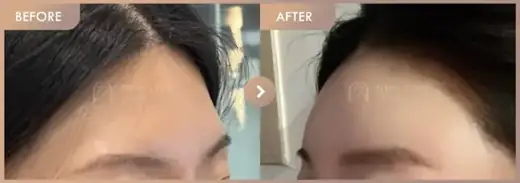 Forehead fillers: before-and-after comparison at Newstar Clinic
