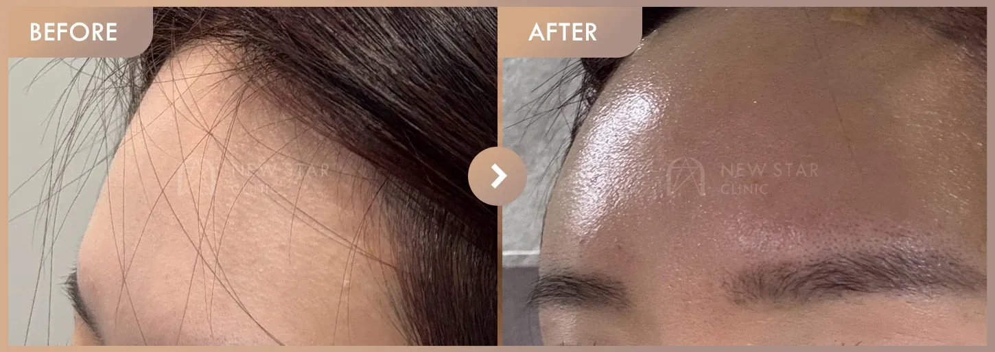 Forehead fillers before-and-after photos at Newstar Clinic