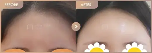 Forehead fillers: before-and-after comparison at Newstar Clinic