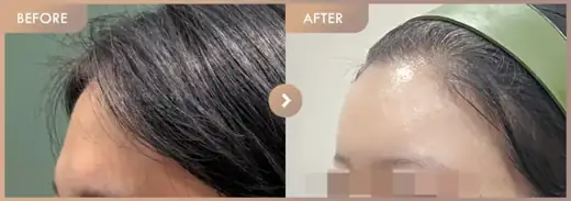 Forehead fillers: before-and-after comparison at Newstar Clinic