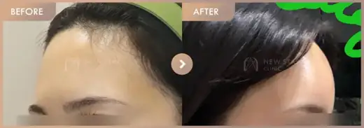 Forehead fillers: before-and-after comparison at Newstar Clinic