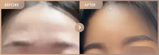 Forehead fillers: before-and-after comparison at Newstar Clinic
