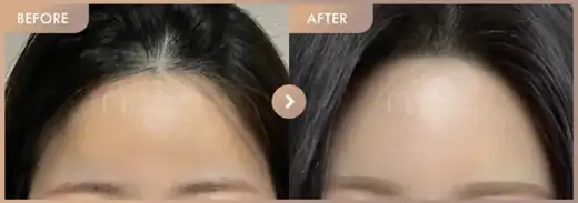 Forehead fillers: before-and-after comparison at Newstar Clinic