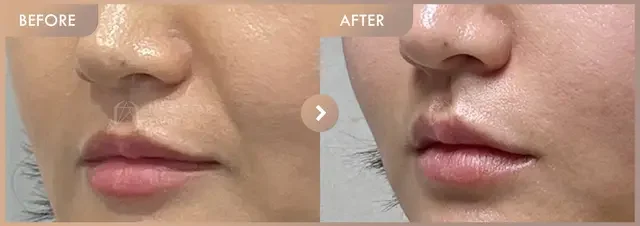 Lip comparison: an angled close-up: before-and-after comparison at Newstar Clinic