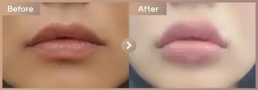 Lip filler: before-and-after comparison at Newstar Clinic