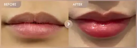 Lip fillers: before-and-after comparison at Newstar Clinic