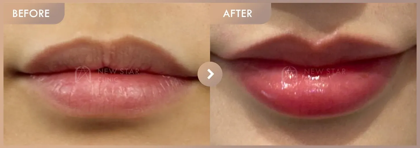 Lip fillers before-and-after photos at Newstar Clinic