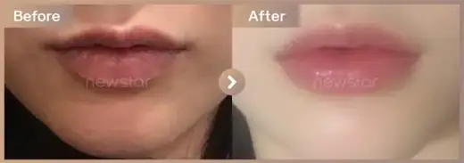 Lip filler: before-and-after comparison at Newstar Clinic