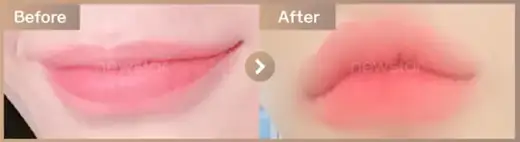 Lip filler: before-and-after comparison at Newstar Clinic