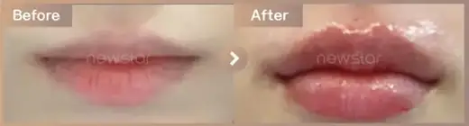 Lip filler: before-and-after comparison at Newstar Clinic