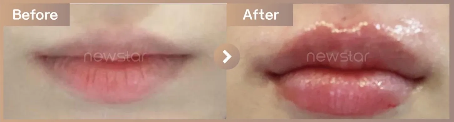 Lip filler before-and-after photos at Newstar Clinic