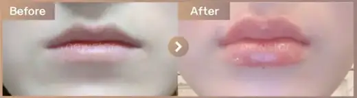 Lip filler: before-and-after comparison at Newstar Clinic