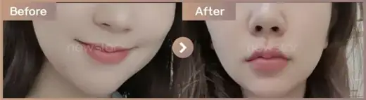 Lip filler: before-and-after comparison at Newstar Clinic